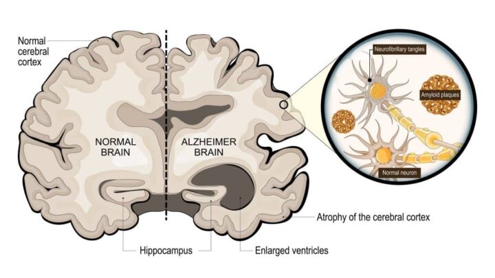Comparação de cérebro de pessoa saudável com o de uma pessoa com Alzheimer