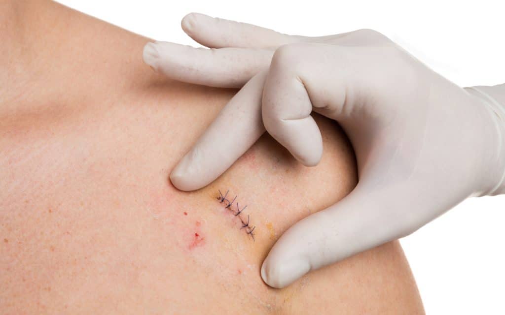 Pontos cirúrgicos aplicados no ombro de um paciente